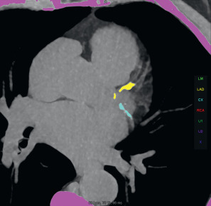 Figure 30.1, Evaluation of calcium scoring and Agatston score in a 77-year-old male patient. Material with a high density (threshold, 130 Hounsfield units) is automatically identified by the software and rendered in pink. Manual allocation of focal coronary calcium spots has been performed and extensive calcifications in the left anterior descending (yellow) and circumflex (turquoise) coronary artery segments are visualized on maximum-intensity projections. The total Agatston score in this patient was 387.8.