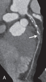 Figure 30.2, Correlation of coronary stenosis and myocardial perfusion deficit. (A) Coronary CT angiography demonstrates multiple mixed plaques of the left anterior descending coronary artery (arrow). (B) Color-coded CT myocardial perfusion imaging shows a focal anteroseptal perfusion deficit in the corresponding vessel territory. Red indicates peak values for myocardial blood volume; purple indicates lowest values.