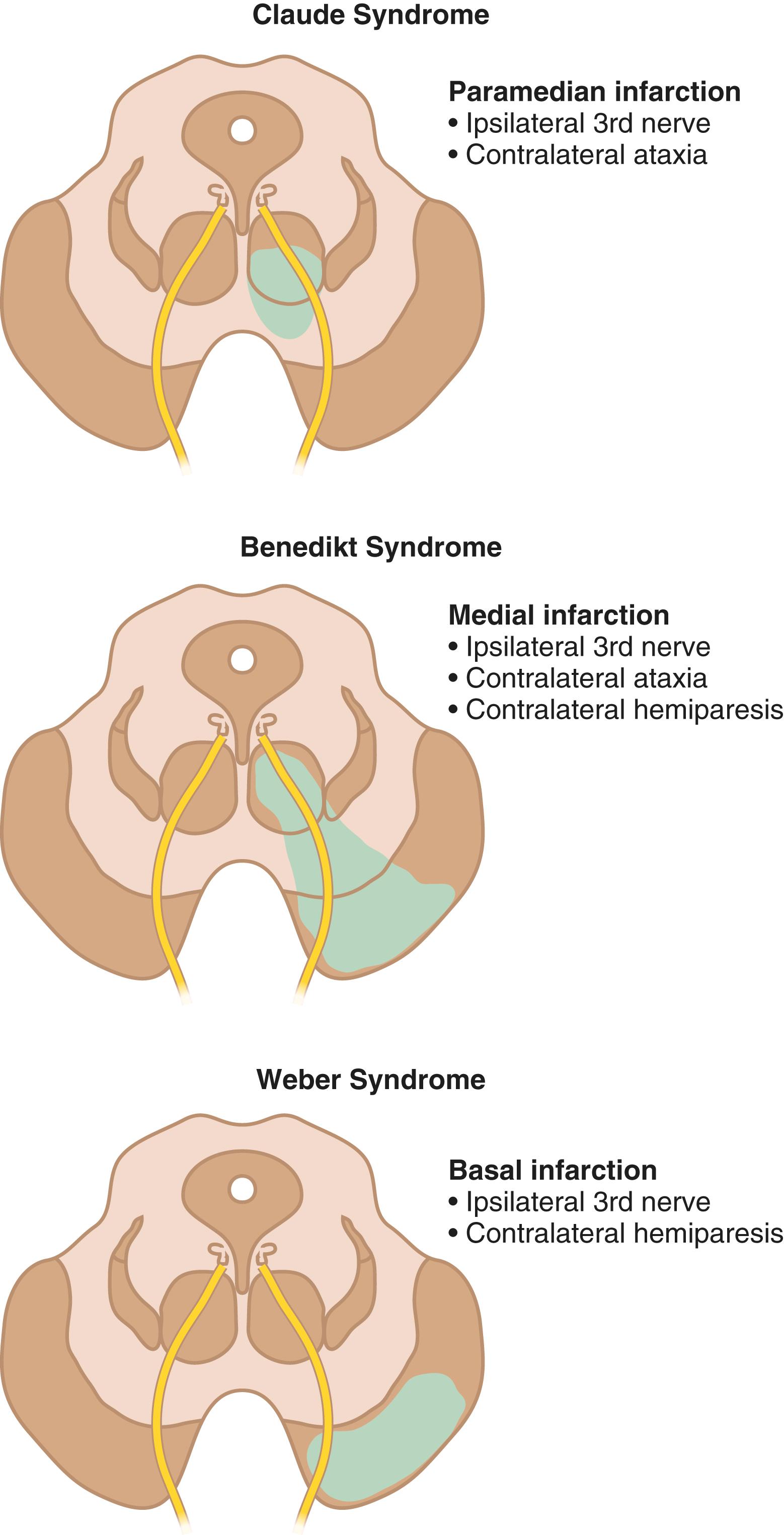 E-FIGURE 376-1, Midbrain stroke syndromes.