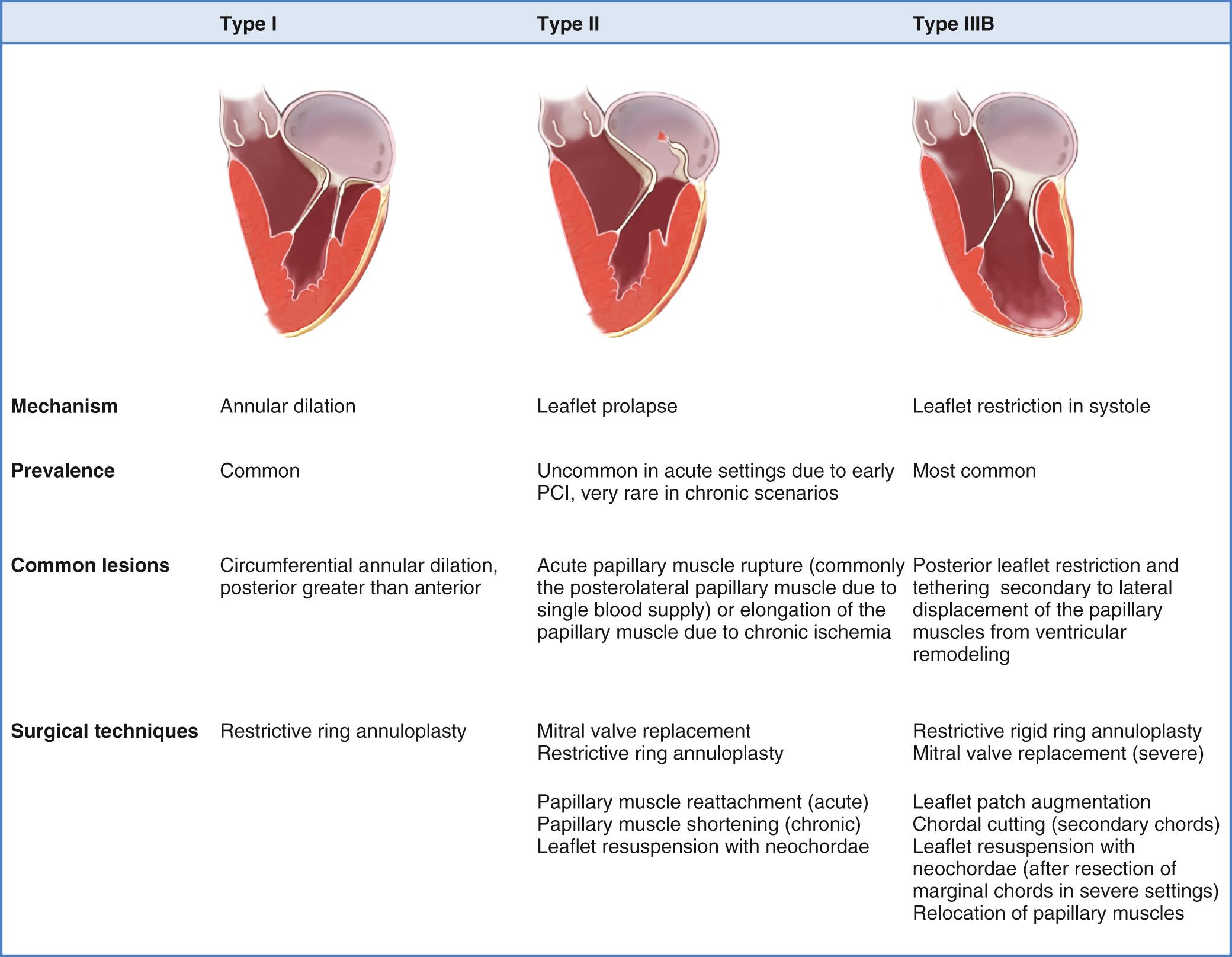 FIGURE 92-1, Carpentier's functional classification in ischemic mitral regurgitation (MR). Type I has normal leaflet motion, and MR is based on annular dilation. Type II dysfunction implies excess leaflet motion with the free edge of the leaflets above the annular plane during systole, which can occur because of papillary muscle rupture (acute infarction) or papillary muscle elongation (chronic). Type IIIB is the most common form of ischemic MR; it results from restricted leaflet motion during systole secondary apical and lateral papillary muscle displacement. PCI, Percutaneous coronary intervention.