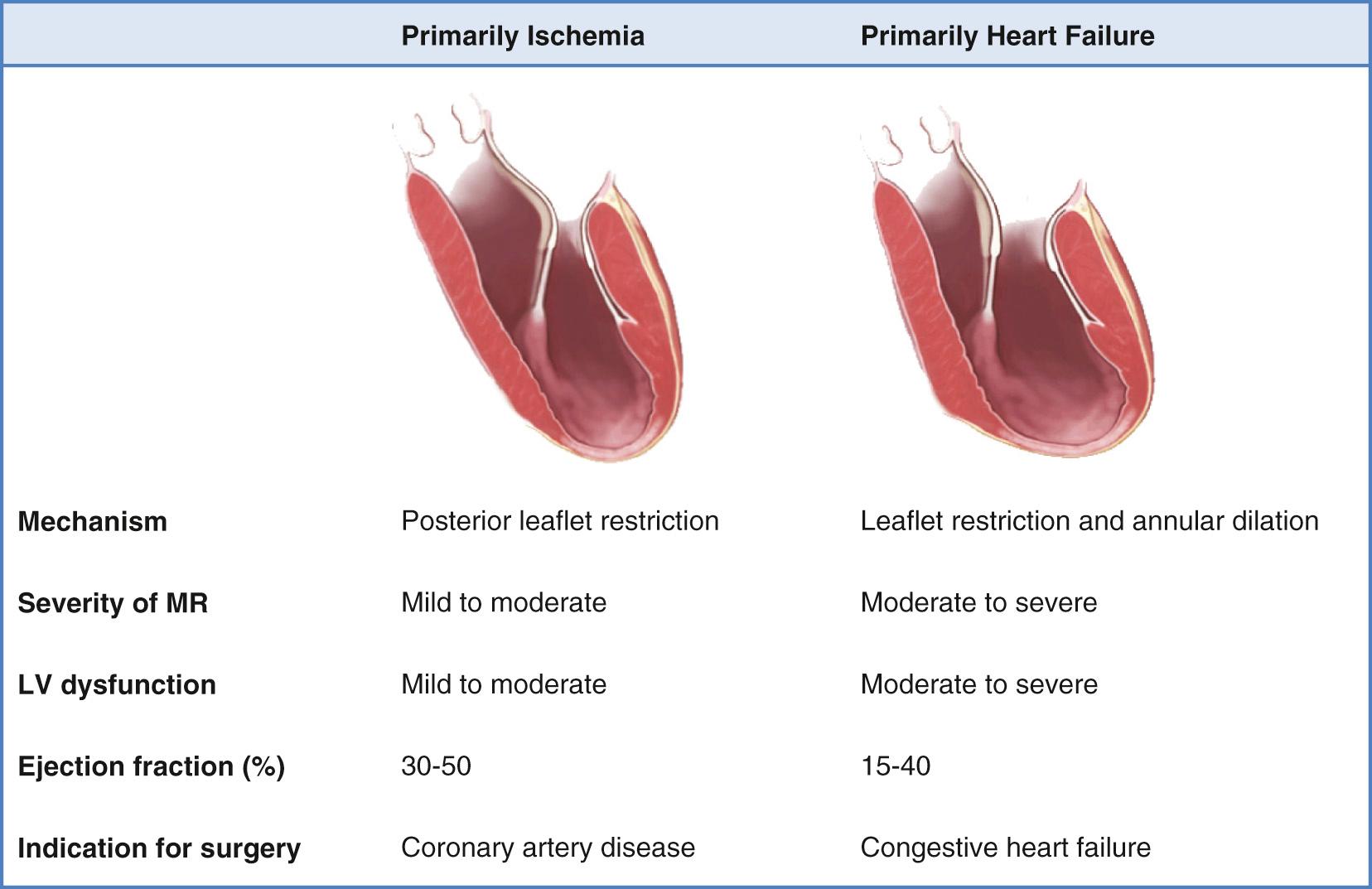 FIGURE 92-2, The two most common and relatively distinct clinical scenarios for patients with ischemic mitral regurgitation. Most patients have primarily ischemic symptoms, and they are noted on evaluation for coronary bypass surgery to have mild to moderate mitral regurgitation. A significant minority, however, primarily have symptoms of congestive heart failure and are noted on evaluation for mitral valve surgery to have significant coronary artery disease. Patients in the latter group tend to have worse left ventricular function. LV, Left ventricular; MR, mitral regurgitation.