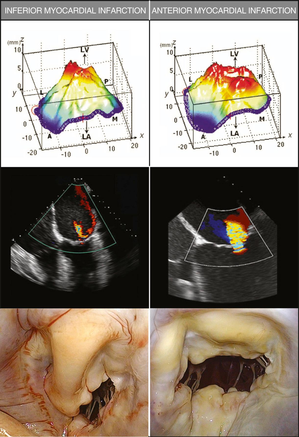 FIGURE 92-4, Tenting and tethering of mitral leaflets into the left ventricle (LV) in patients with ischemic mitral regurgitation. Areas of greatest displacement are shown in red . For patients with inferior infarction, tenting of leaflet is more localized with less bulging. For patients with anterior infarction, mitral valve leaflets are widely tethered and bulge toward the LV. The tethered leaflet area is smaller in inferior than in anterior myocardial infarction. A, Anterior; L, lateral; LA, left atrium; M, medial; P, posterior.