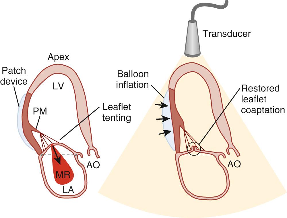 FIGURE 92-6, Patch placement and balloon inflation over infarct region (black) to reposition displaced papillary muscle (PM) toward anterior annulus and relieve tethering and mitral regurgitation (MR) under ultrasound guidance in a beating heart. AO, Aorta; LA, left atrium; LV, left ventricle.