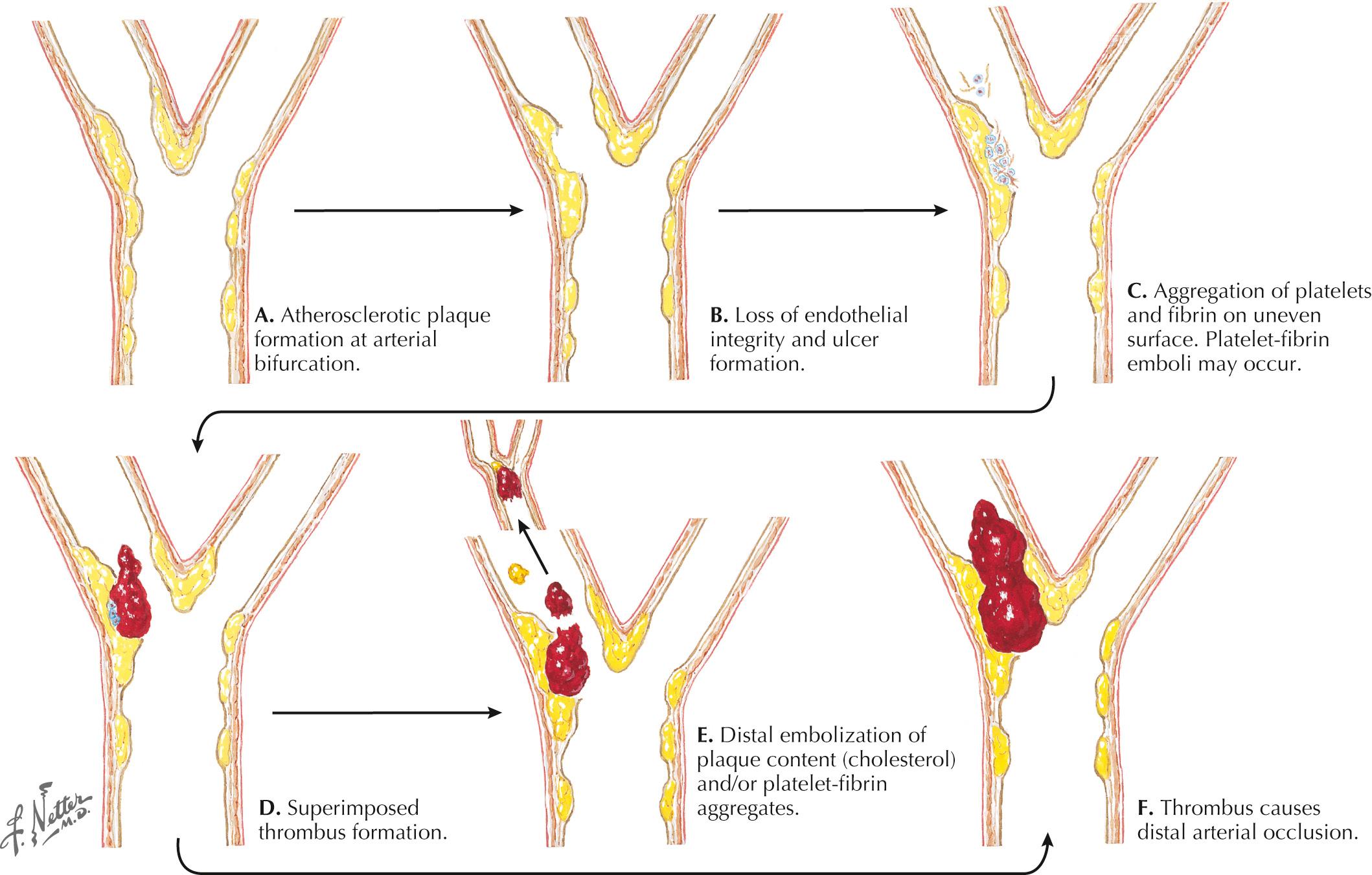 Fig. 15.1, Atherosclerosis, Thrombosis, and Embolism.