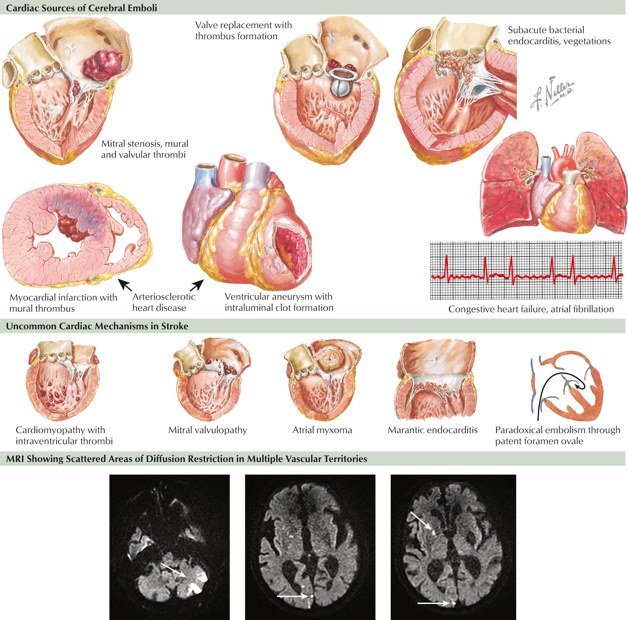 Fig. 15.4, Cardiac Embolism.