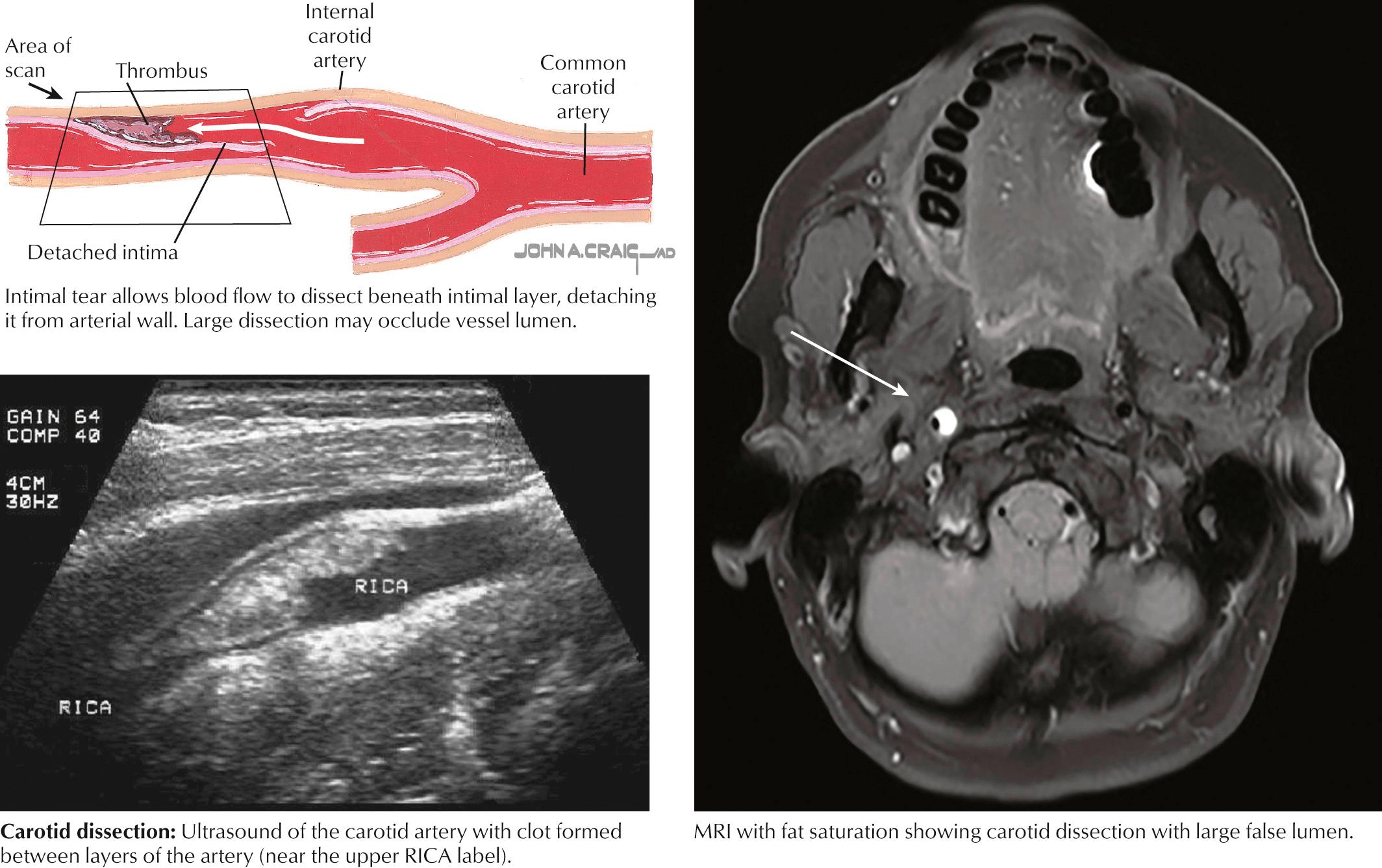 Fig. 15.6, Arterial Dissection.