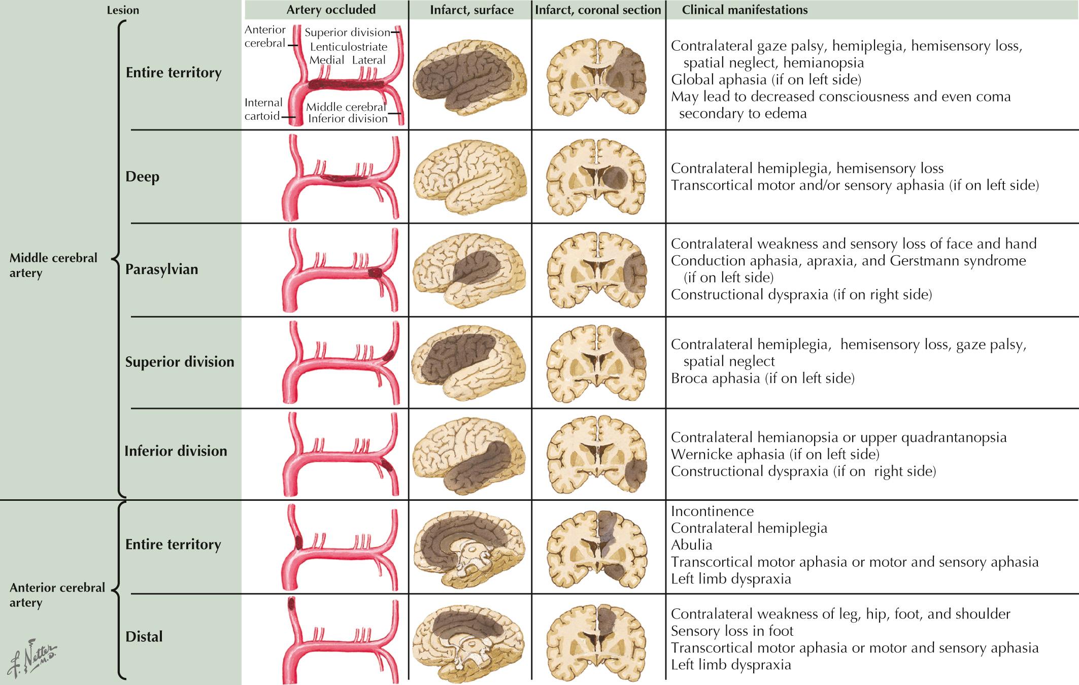 Fig. 15.8, Occlusion of Middle and Anterior Cerebral Arteries.