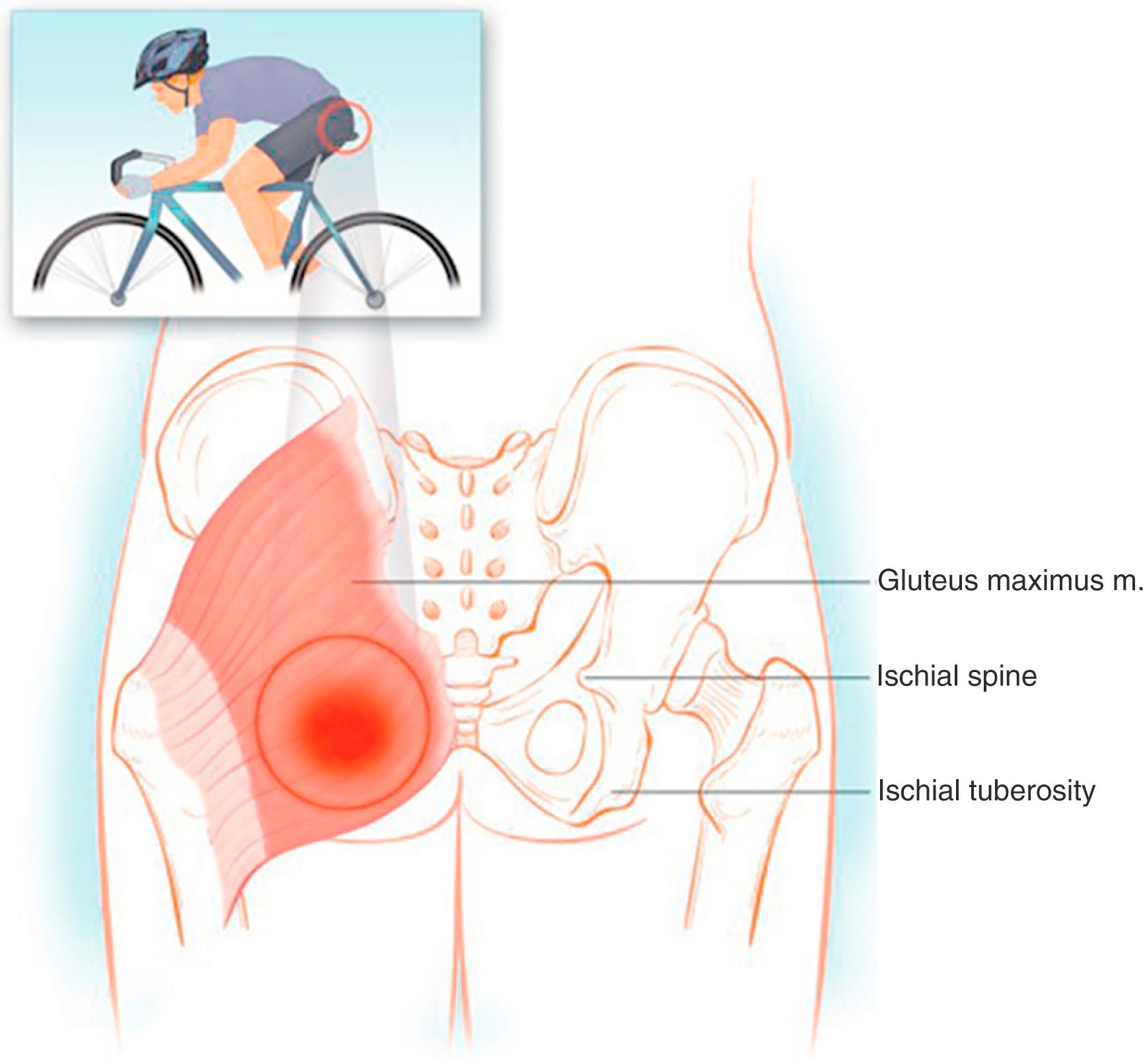 FIG. 125.1, The ischial bursa is vulnerable to injury from both acute trauma and repeated microtrauma. Acute injuries are caused by direct trauma to the bursa from falls onto the buttocks and from overuse, such as prolonged riding of horses or bicycles.