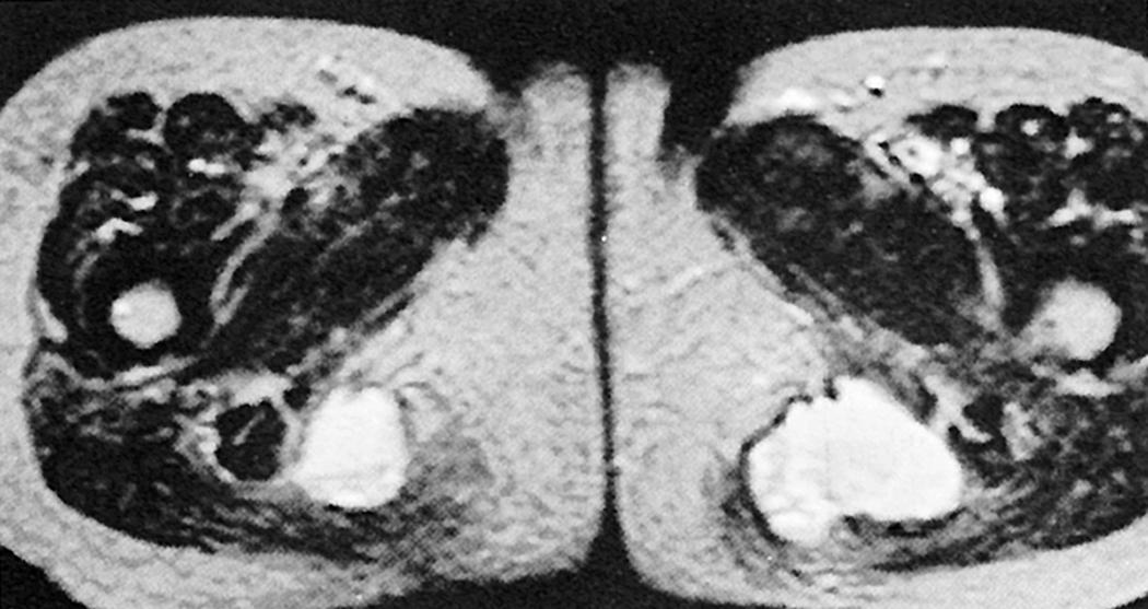 FIG. 125.3, Ischial bursitis: magnetic resonance (MR) imaging. A transaxial T2-weighted (repetition time/echo time, 1500/90) spin-echo MR image shows evidence of bilateral ischial bursitis.