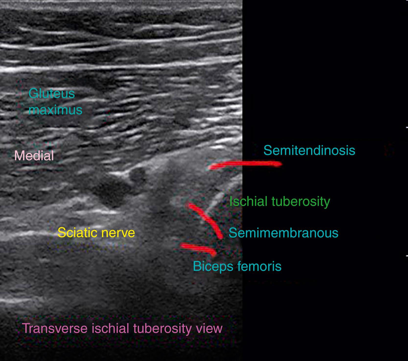 FIG. 125.4, Transverse ultrasound image demonstrating the origins of the hamstring complex at the ischial tuberosity.