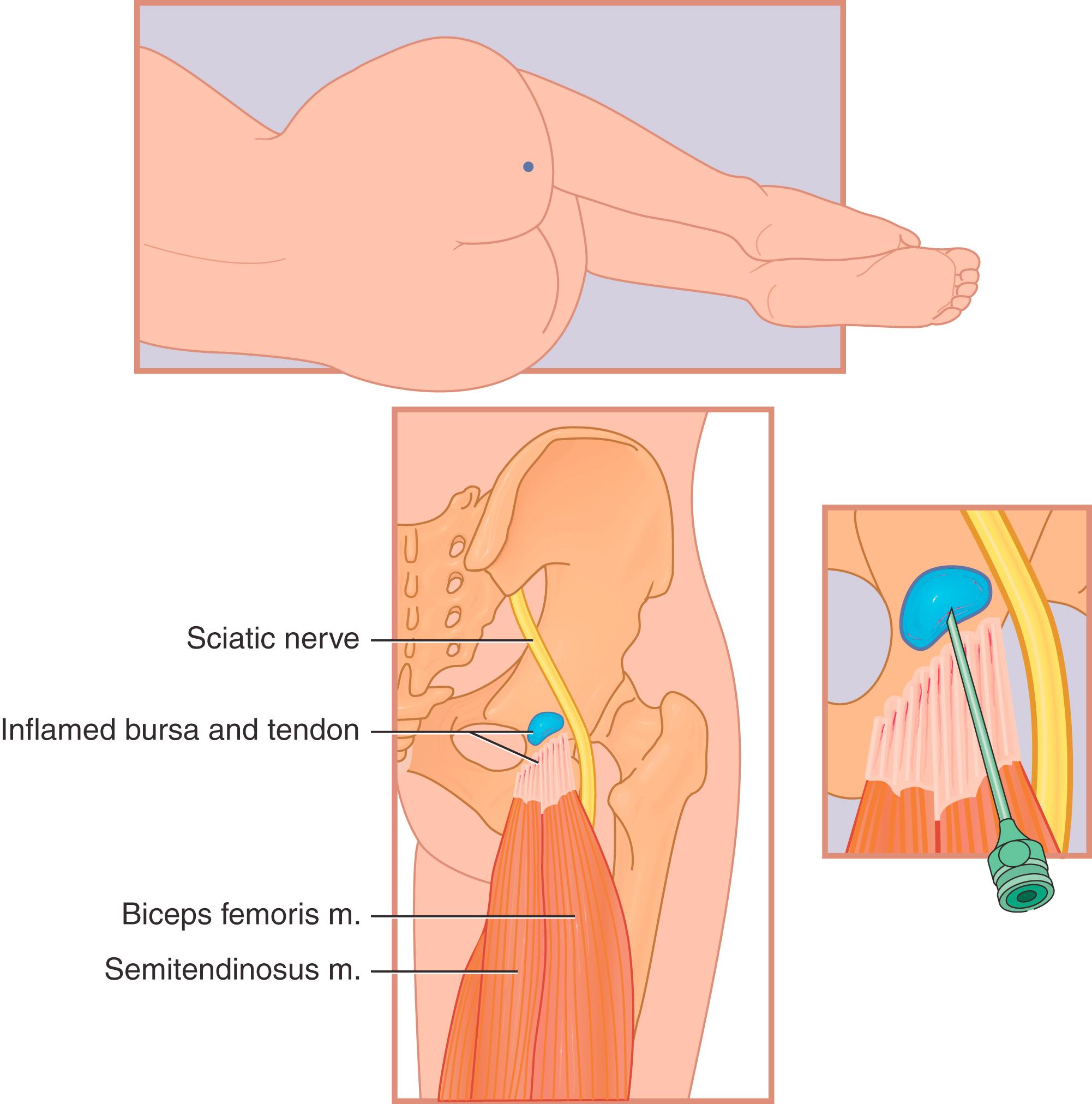 FIG. 125.5, Proper needle placement for injection of the ischial bursa. m ., Muscle.