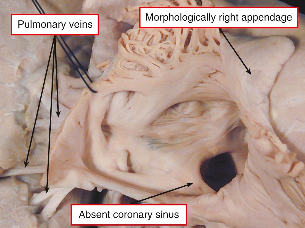 Fig. 26.13, Heart with all the pulmonary veins returning to the right-sided atrium, which has an appendage of right morphology. In anatomic terms, this is totally anomalous pulmonary venous connection. Note the absence of the coronary sinus.