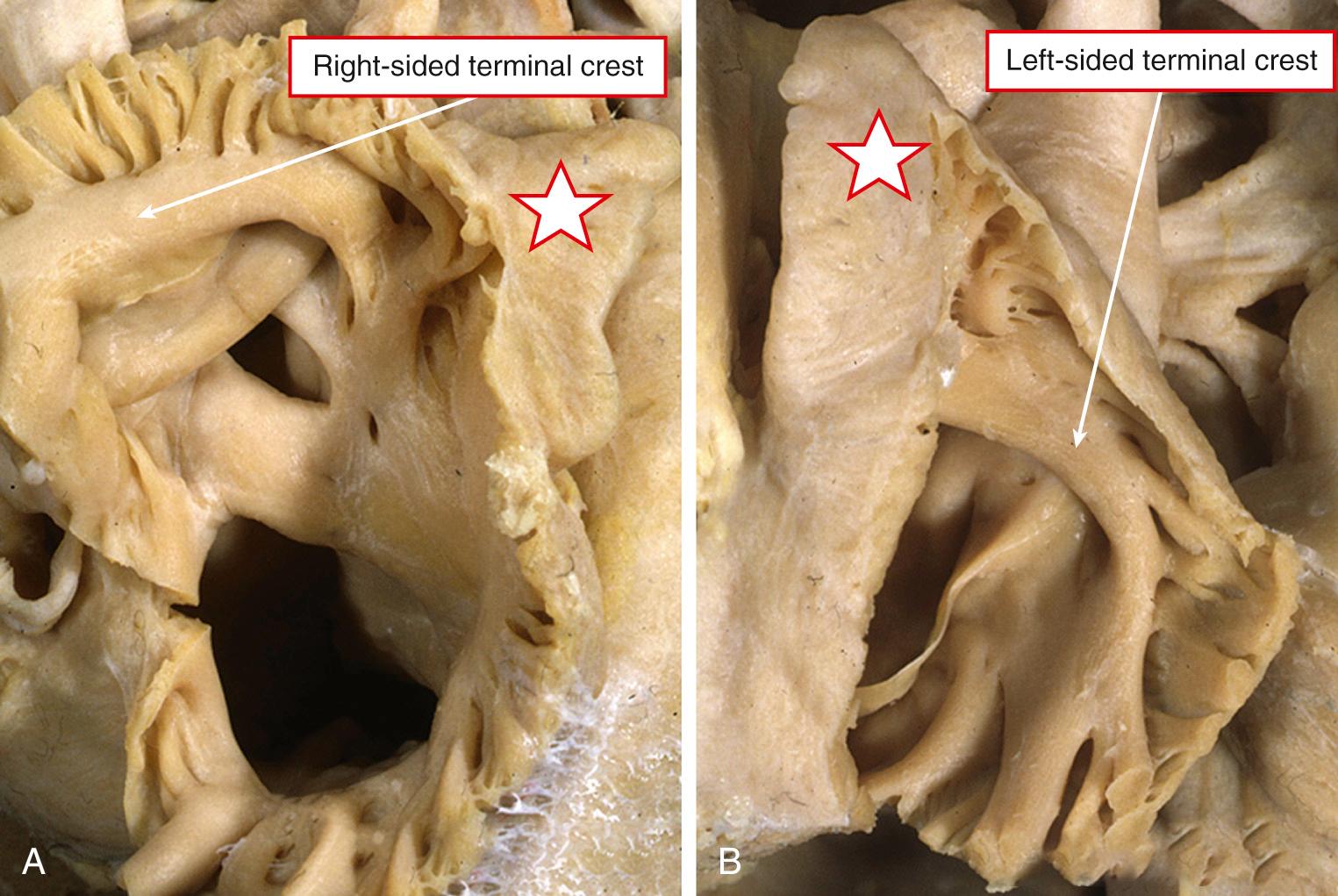 Fig. 26.15, Internal aspect of the right-sided (A) and left-sided (B) atrial chambers from a patient with isomeric right atrial appendages. The presence of terminal crests bilaterally is obvious.