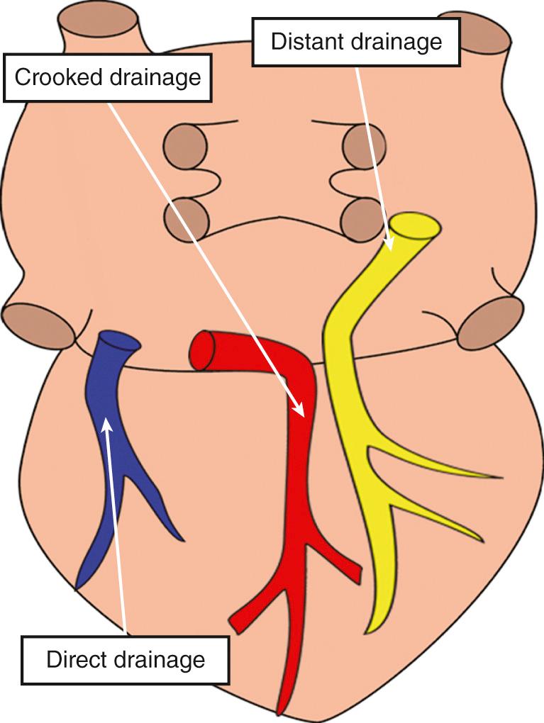 Fig. 26.16, Inferior surface of a heart with isomeric atrial appendages illustrating the concept of direct, crooked, and distant return of coronary venous drainage when the coronary sinus is absent.