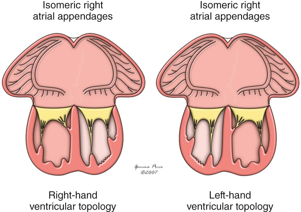 Fig. 26.17, Concept of biventricular and mixed atrioventricular connections. The connections would still be mixed if the appendages were of left morphology bilaterally, rather than the isomeric right variant shown in Fig. 26.5 .