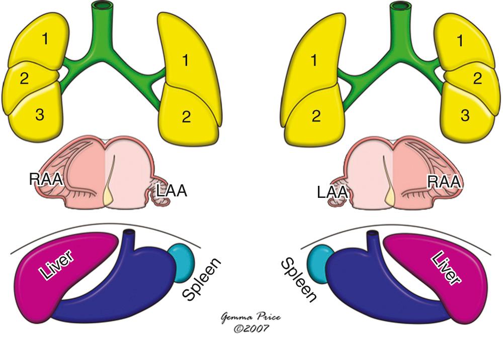 Fig. 26.2, Essence of the usual body arrangement (left) and its mirror image (right) . Individuals with these arrangements would exhibit enantiomerism relative to each other. LAA, Left atrial appendage; RAA, right atrial appendage.