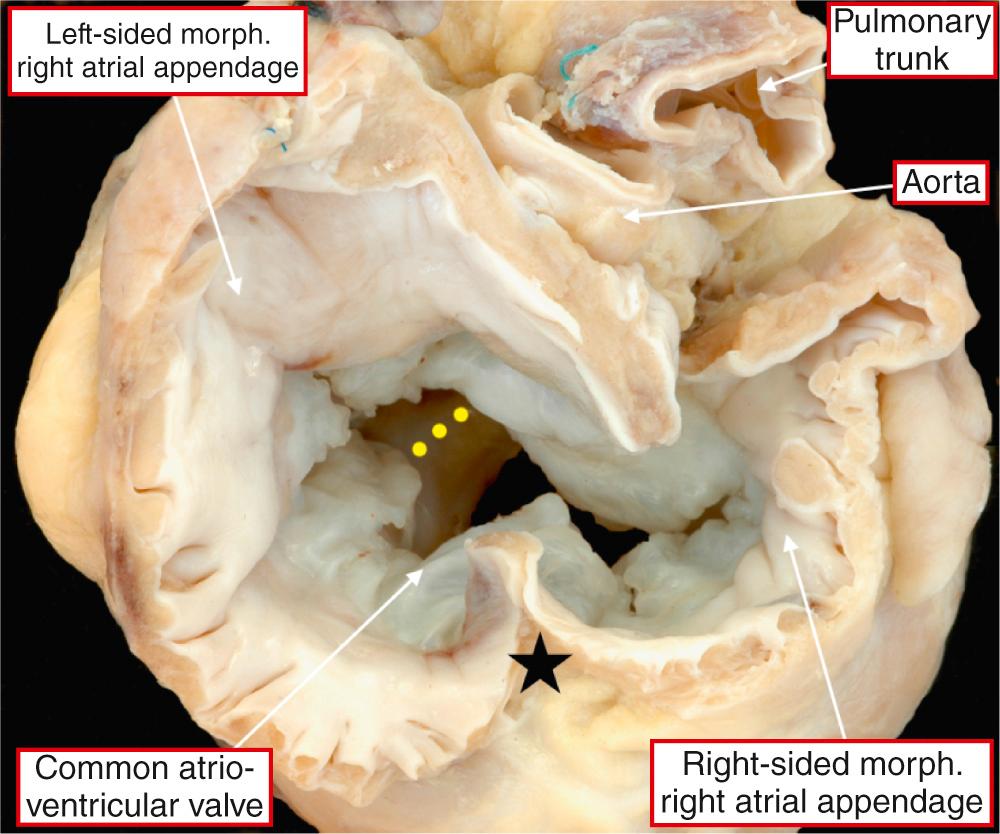 Fig. 26.3, Short-axis view of the base of the heart illustrating an unbalanced common atrioventricular junction with a common atrioventricular valve and right dominance. The interventricular septum (yellow dots) is easily appreciated. The pectinate muscles extend around both atrioventricular junctions to the crux of the heart (star) in this patient with isomerism of the right atrial appendages.