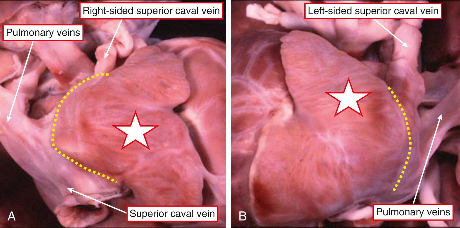 Fig. 26.4, Triangular appendages (stars) on the right (A) and left (B) sides in a patient with right isomerism. Note the bilateral superior caval veins and the pulmonary veins coming together in a midline confluence. The yellow dots show the bilateral terminal grooves.