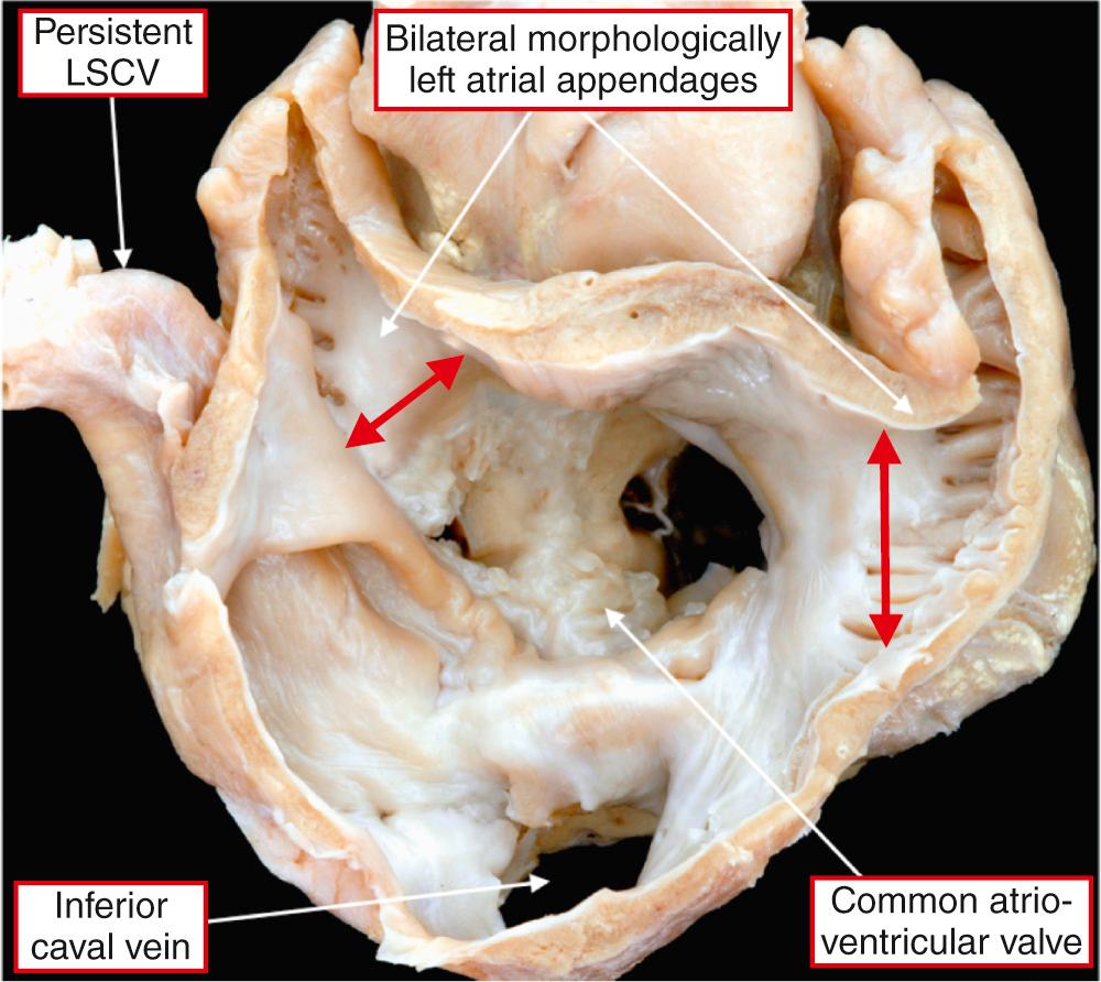 Fig. 26.5, Short-axis view of the base of the heart illustrating a common atrioventricular junction with a common atrioventricular valve that has separate right and left orifices. The bridging leaflets are adherent to the interventricular septum and to one another. The atrial appendages are bilaterally morphologically left with the characteristic tubular appearance and the narrow or constricted junction (arrows) to the smooth-walled vestibules. Note the left-sided persistent left superior caval vein (LSCV).