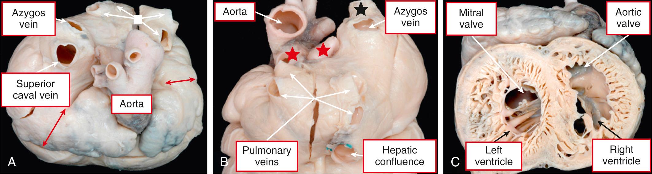Fig. 26.8, Heart with isomerism of the left atrial appendages demonstrating quasi-usual venous relationships. (A) The base of the heart shows bilateral tubular appendages and their narrow junctions (red arrows) with the atrial vestibule. There is a right-sided superior caval vein with a large azygos vein indicative of azygos continuation of the inferior caval vein. The pulmonary veins drain to the left-sided atrium ( white box and arrows ). (B) The posteroinferior view of the same heart. The superior caval vein is marked with a black star and the right and left pulmonary veins with red stars. (C) Short-axis view of the same heart demonstrating so-called noncompaction of both ventricles and the interventricular septum. There was also transposition.