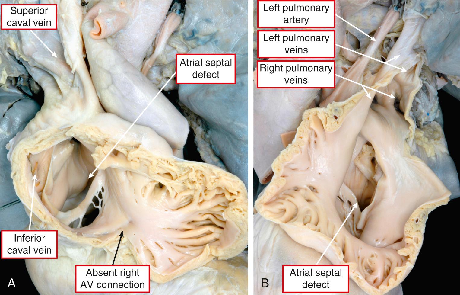 Fig. 26.9, Heart with isomerism of the right atrial appendages and tricuspid atresia demonstrating quasi-usual venous relationships. Pectinate muscles extend to the crux on both the right (A) and left sides (B). In A, the superior and inferior caval veins drain to the right-sided atrium; in B, the pulmonary veins drain to the left-sided atrium. Note the large atrial septal defect. AV, Atrioventricular.