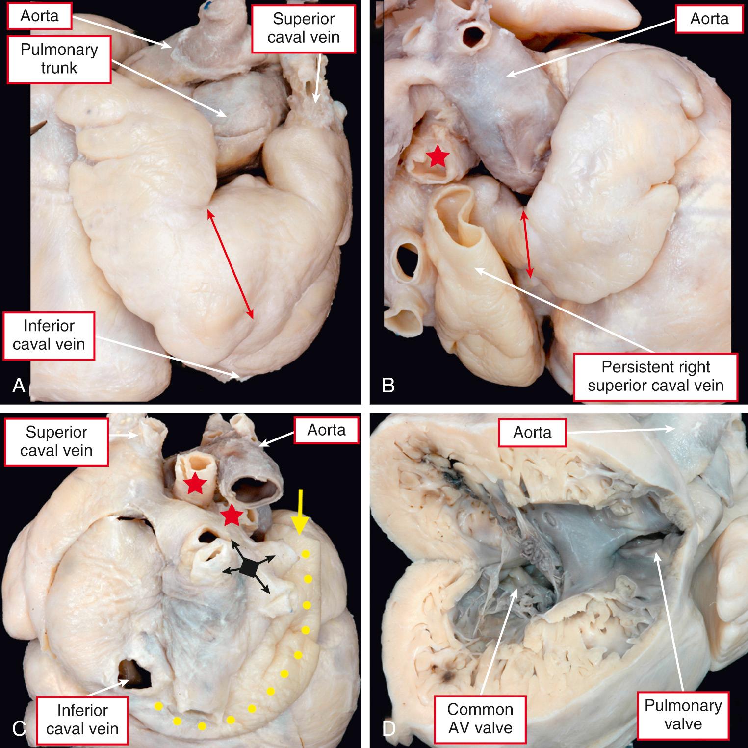 Fig. 26.10, Heart with isomerism of the left atrial appendages and quasi-mirror image venous relationships. (A–B) Bilateral tubular appendages have a narrow junction (red arrows) with the atrial vestibule. (A) The superior caval vein is left-sided. (B) A persistent right superior caval vein drained to the coronary sinus (not seen). The red star indicates the right pulmonary artery. (C) Posteroinferior aspect demonstrating the left-sided superior and inferior caval veins and the right-sided persistent right superior caval vein (yellow arrow) draining to the left-sided coronary sinus (yellow dots) . (D) The right ventricle is opened in clamshell fashion to show the common atrioventricular (AV) valve. The apex of this heart was to the right, and there is right-hand topology.