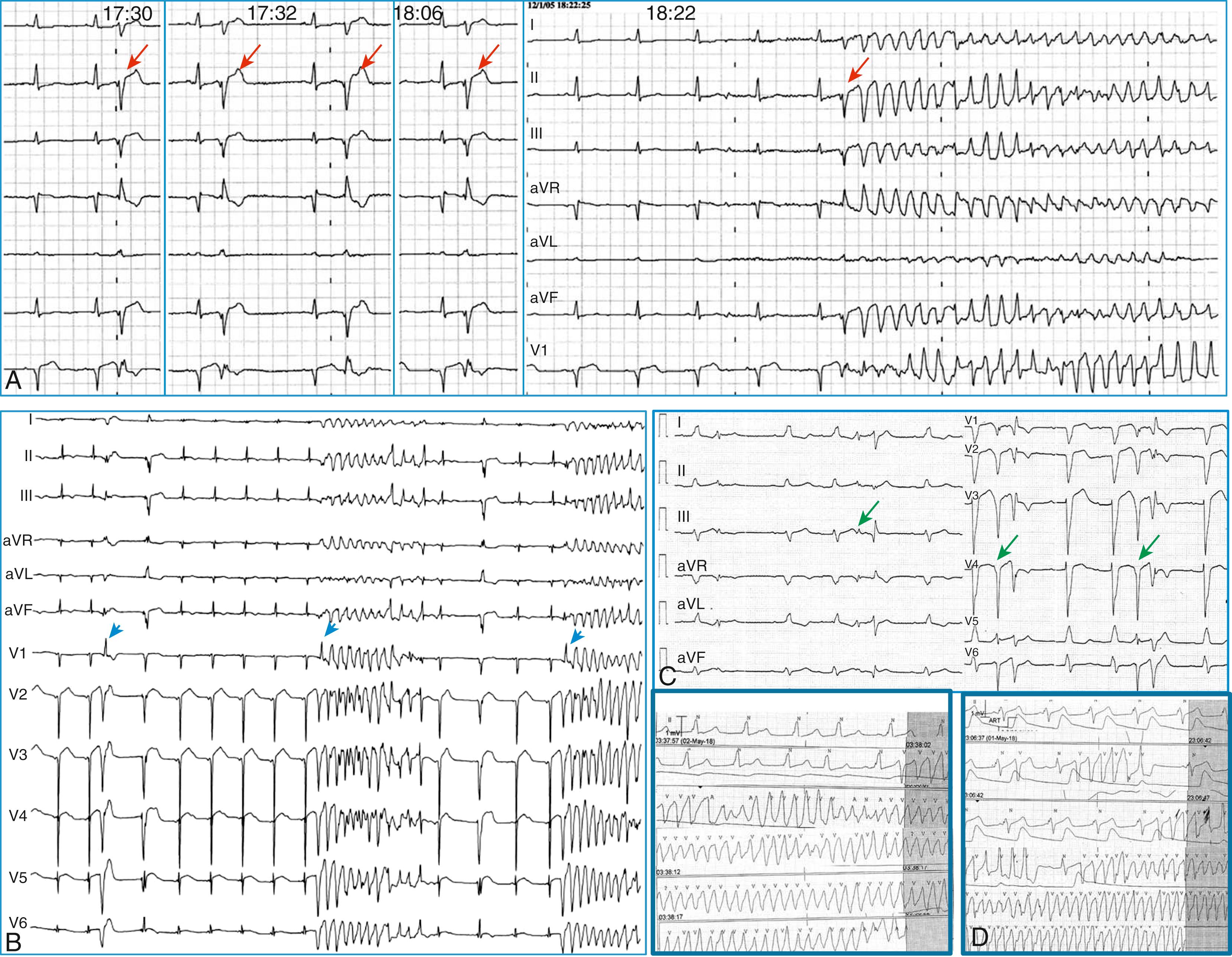 Fig. 99.3, Polymorphic ventricular tachycardia triggered by ectopic beats with relatively narrow QRS complexes and short coupling intervals.