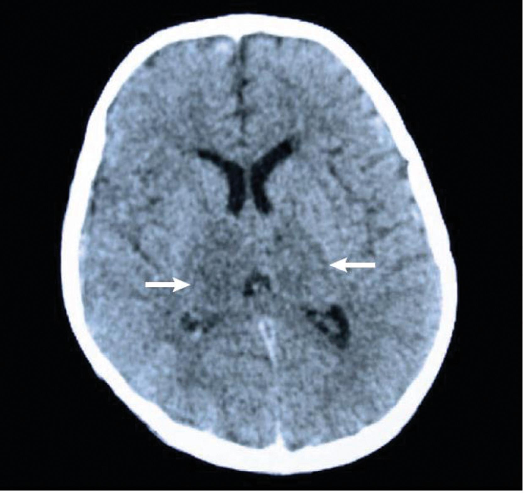 Fig. 35.4, Computerized tomography (CT) scan showing bilateral thalamic hypodensities in a 7-year-old child with Japanese encephalitis (JE) in Ho Chi Minh City, Vietnam. The thalamic hypodensities are illustrated with white arrows. In children and adults with suspected central nervous system infections in JE-endemic southern Vietnam, this CT scan finding had a sensitivity of 22% and specificity of 100% for diagnosis of JE. However, this finding can also be seen with other flaviviral encephalitides, so the local epidemiology must always be taken into consideration.