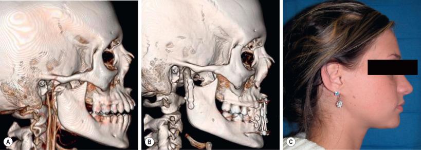 FIG. 3.10.3, (A) 3D CT of right subcondylar fracture; (B) following open reduction and internal fixation via retromandibular extraoral approach; (C) lateral 1 year post-operative.