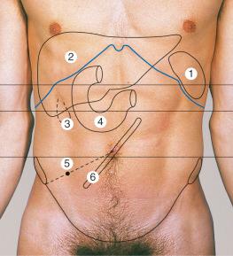 Figure 38.6, Abdominal wall anatomic landmarks. (1) spleen; (2) liver; (3) gallbladder; (4) duodenum; (5) appendix; (6) root of small bowel mesentery. For the open approach, a standard midline incision is made from xiphoid to pubic tubercle. In this illustration, one can see the approximate location of the root of the mesentery (6), and the end of the duodenum (4), which marks the beginning of the jejunum at the ligament of Treitz.