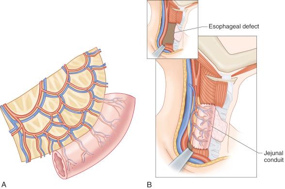 Figure 38.7, (A) The standard flap is depicted as a jejunal conduit. (B) Jejunal conduit placed for cervicoesophageal reconstruction.