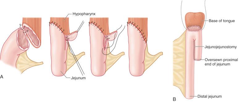 Figure 38.8, Different ways to adapt the diameter of the hypopharynx and the jejunum. (A) The hypopharynx can be modified to fit the diameter of the jejunum. (B) The double-barreled jejunum.