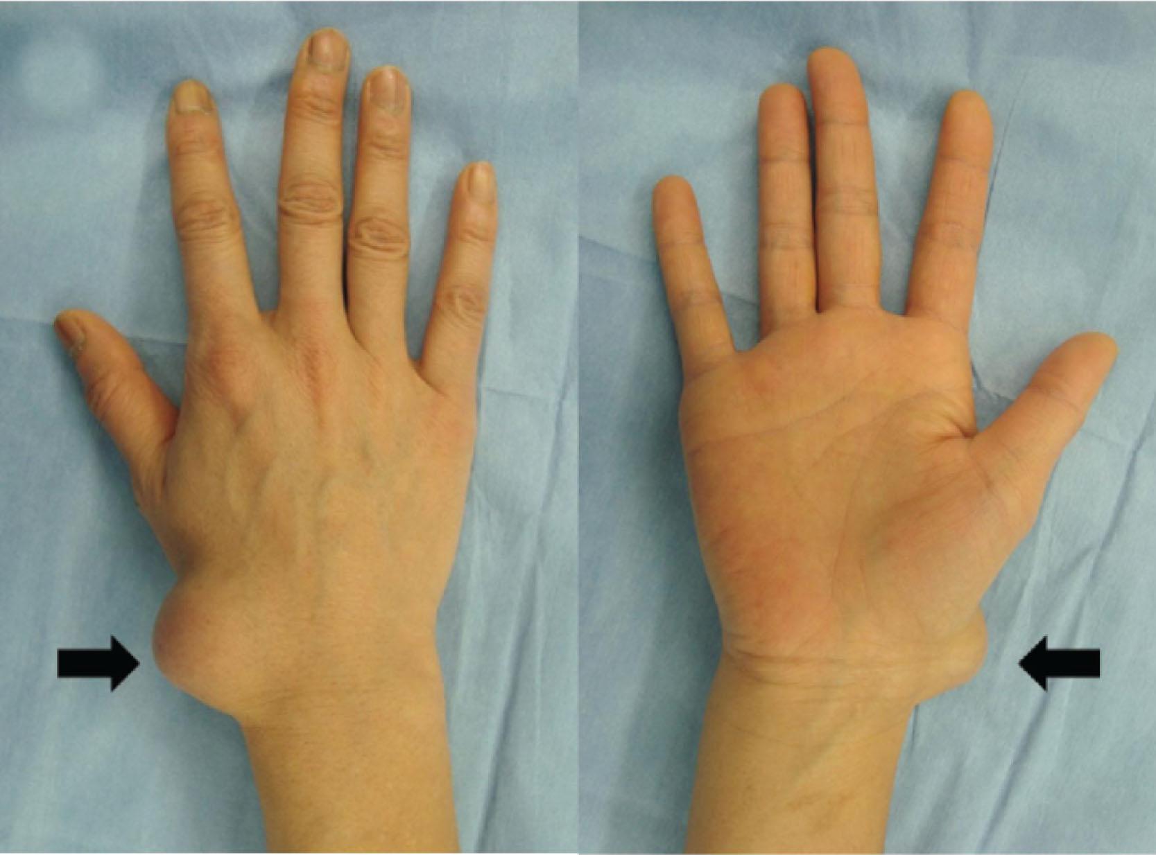 Fig. 8.1, Large dorsal ganglion cyst of the right wrist.