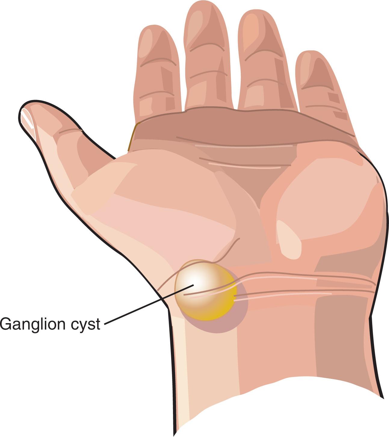 Fig. 8.2, The extreme flexion/extension test for ganglion cyst of the wrist. To perform the extreme flexion/extension test for ganglion cyst of the wrist, the examiner first localizes the ganglion cyst to the dorsal or volar aspect of the wrist. If the ganglion is on the dorsal aspect, the examiner forcefully flexes the patient’s affected wrist. If the ganglion cyst is located on the volar aspect of the wrist, the examiner forcefully extends the patient’s affected wrist (see illustration) . The extreme flexion/extension test is positive if the forceful flexion or extension of the wrist causes a marked increase in the patient’s pain.