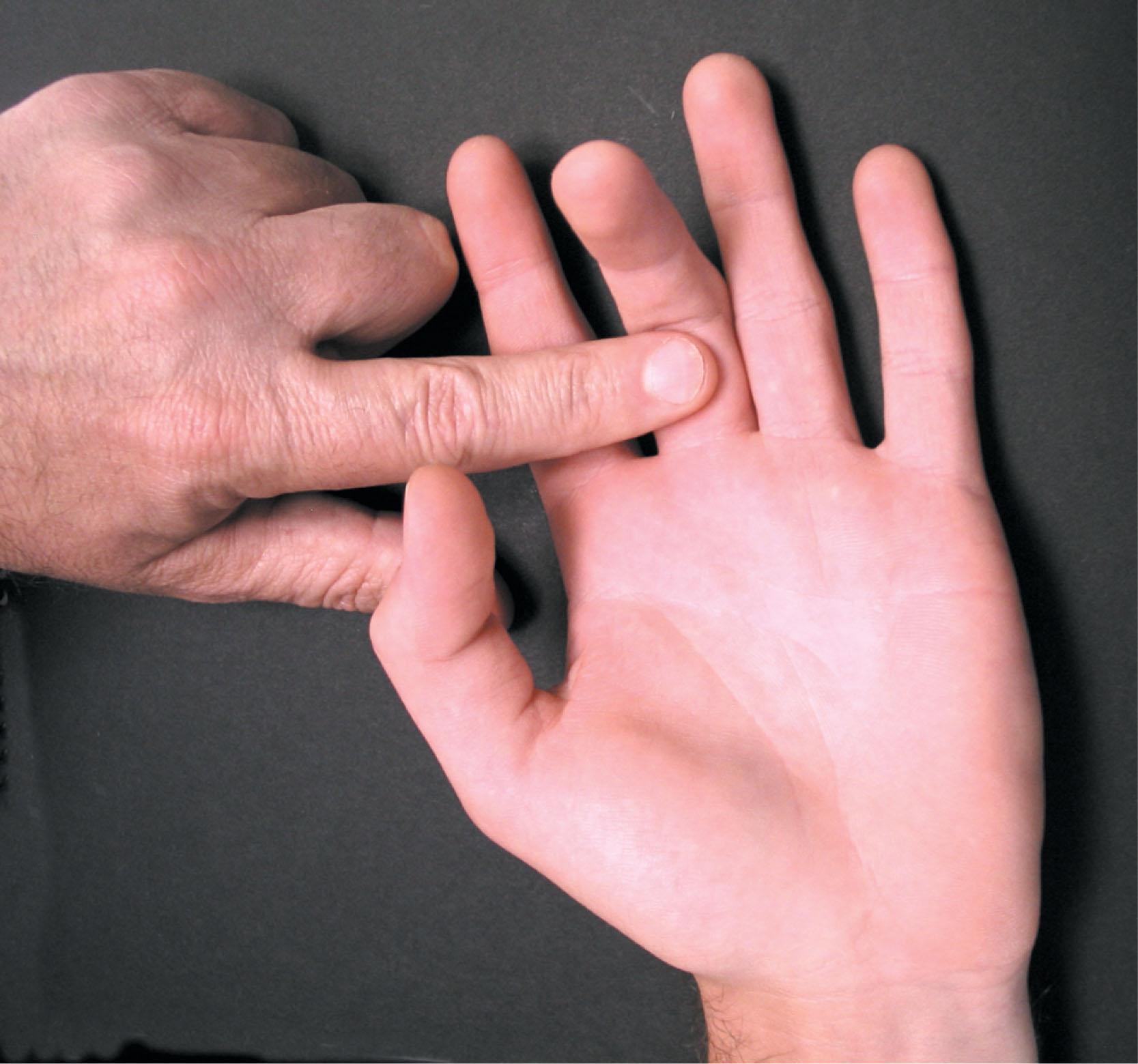 Fig. 13.1, The catching tendon sign for trigger finger.