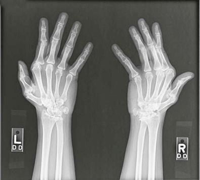 Figure 21-1, The conventional radiograph of a patient with long-standing rheumatoid arthritis shows symmetric destruction of the metacarpophalangeal joints and the small bones of the wrist.