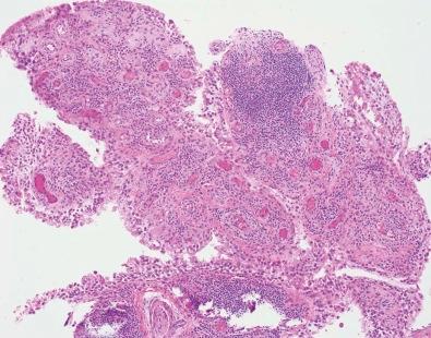 Figure 21-2, Rheumatoid arthritis is characterized by nonsuppurative chronic inflammation with hypertrophy and hyperplasia of the synovial lining cells. Redundant folds of hyperplastic synovial lining cells can form papillary structures similar to those seen in pigmented villonodular synovitis.