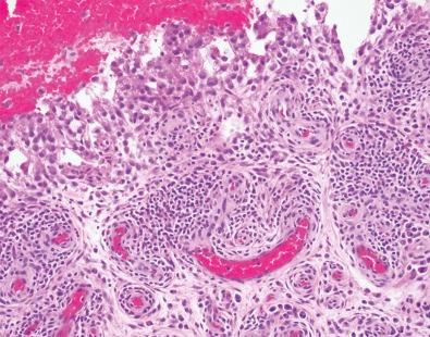 Figure 21-3, In this example of rheumatoid arthritis, lymphoid aggregates cluster in the subintimal region, which also displays a mixed inflammatory infiltrate, including plasma cells, lymphocytes, and mast cells. A fibrinous exudate can be appreciated at the left edge of the image.