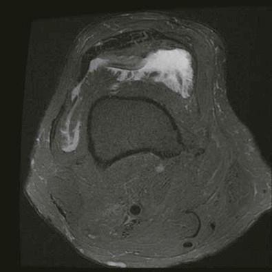 Figure 21-6, Fat-saturated T2-weighted magnetic resonance image of lipoma arborescens shows dark fronds of fatty tissue separated by high signal–intensity synovial fluid.