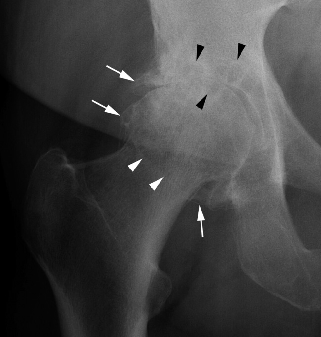 Severe osteoarthritis of the hip. There is joint space narrowing which has occurred asymmetrically within the joint, in this case affecting the superior joint (the most common pattern of hip involvement). Note also subchondral cyst formation (black arrowheads) and osteophytosis (arrows). The osteophytes form a rim around the femoral head/neck junction and are superimposed over the neck visible as a sclerotic line (white arrowheads), which should not be mistaken for a fracture. **