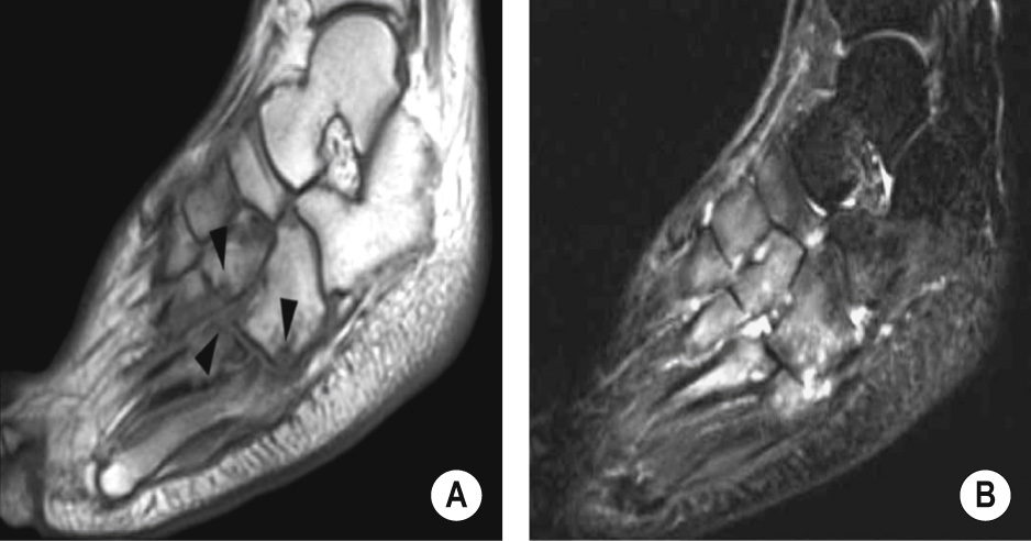 Acute neuropathic osteoarthropathy. (A) Sagittal, T1WI shows marginal erosions (arrowheads) at the Lisfranc joint and intertarsal joints. Note that the surrounding subcutaneous fat is preserved, a finding that would be unlikely in the setting of infection. (B) Sagittal, T2W, fat-suppressed MR image of the same patient shows bone marrow edema with extensive regional distribution around the Lisfranc and intertarsal joints that contain small effusions. ©35