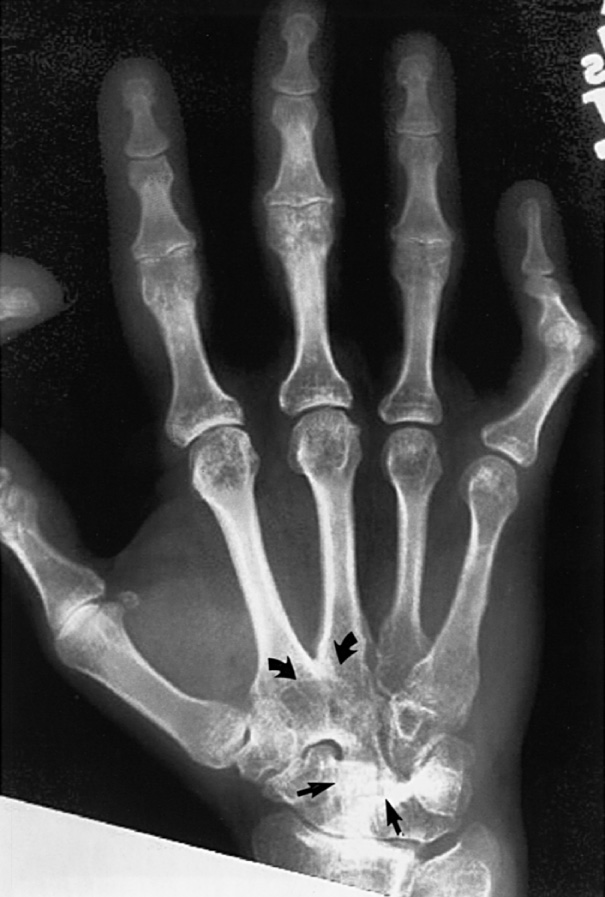 Wrist fusion in juvenile rheumatoid arthritis. Posteroanterior (PA) view of the wrist shows fusion at the second and third carpometacarpal joints (curved arrows). Some of the carpal bones (arrows) are also fused. ©34