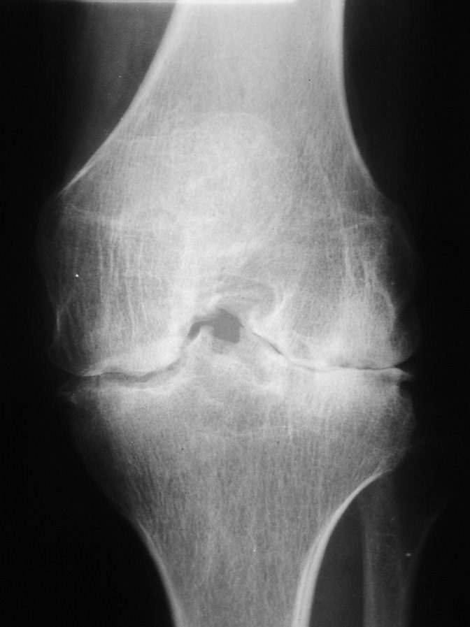 JIA of the knee. There is secondary degenerative change with loss of joint space, subchondral sclerosis associated with epiphyseal overgrowth, and widening of the intercondylar notch. *