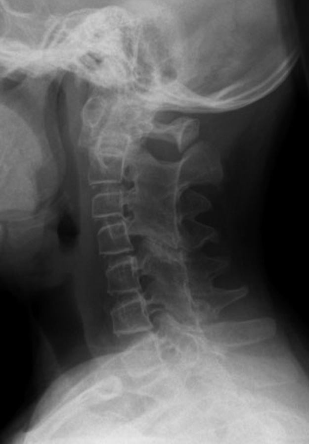 Lateral radiograph of the cervical spine. There is squaring of the vertebral bodies. Note the extensive ankylosis of the facet joints posteriorly and widening of the space anterior to the odontoid.