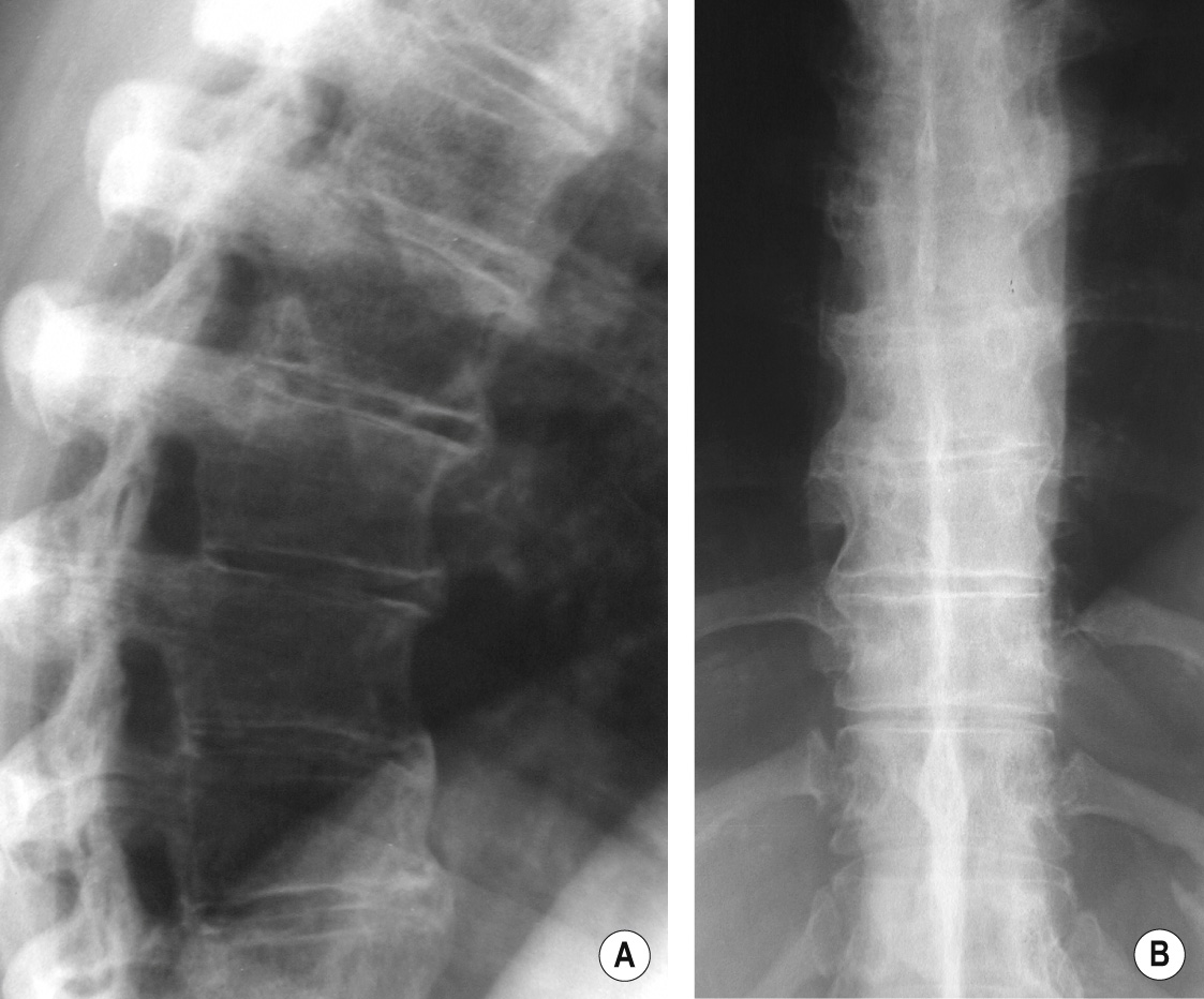 DISH. (A) Lateral and (B) AP XRs show bridging osteophytes at multiple levels, out of proportion to the degree of underlying degenerative change. *