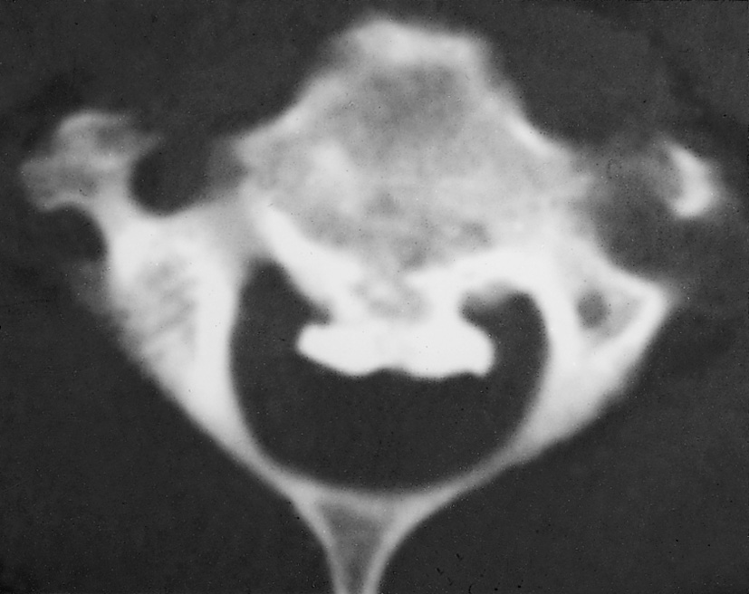 DISH. CT demonstrating ossification of the posterior longitudinal ligament. †