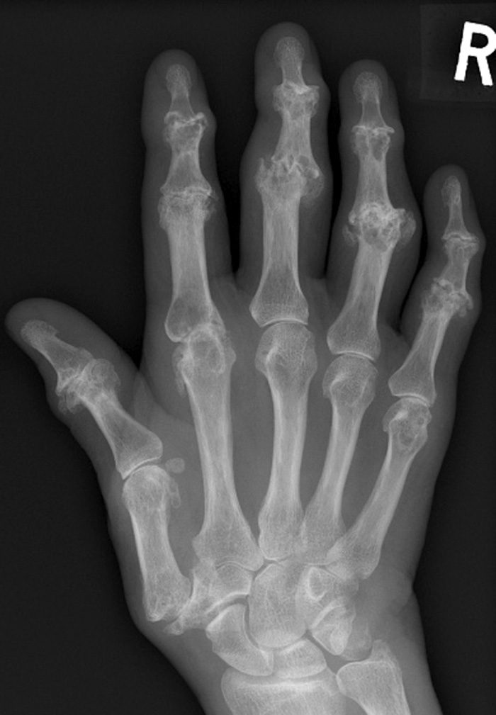 Erosive osteoarthritis. DP radiograph: in addition to the typical osteoarthritis changes seen in multiple joints, including the thumb base carpometacarpal joint, there is erosive change seen at many of the interphalangeal joints. The majority of these are central in location (subchondral) and give rise to the characteristic ‘seagull wing’ appearance of the distal articular surface (seen for example at the index, middle and ring distal interphalangeal joints). **