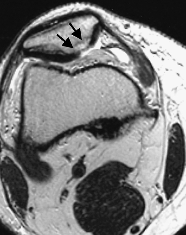 Chondromalacia patellae. T2WI MRI demonstrates denuded cartilage on the medial patella facet, with cystic change in the underlying bone (arrows). *