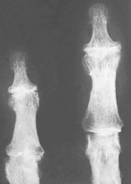 Osteoarthritis with joint narrowing and osteophyte formation (Heberden's nodes). †