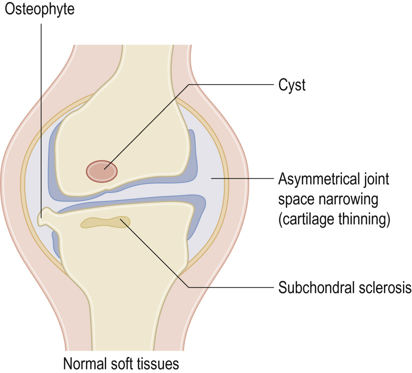 Schematic diagram showing typical joint changes associated with osteoarthritis.